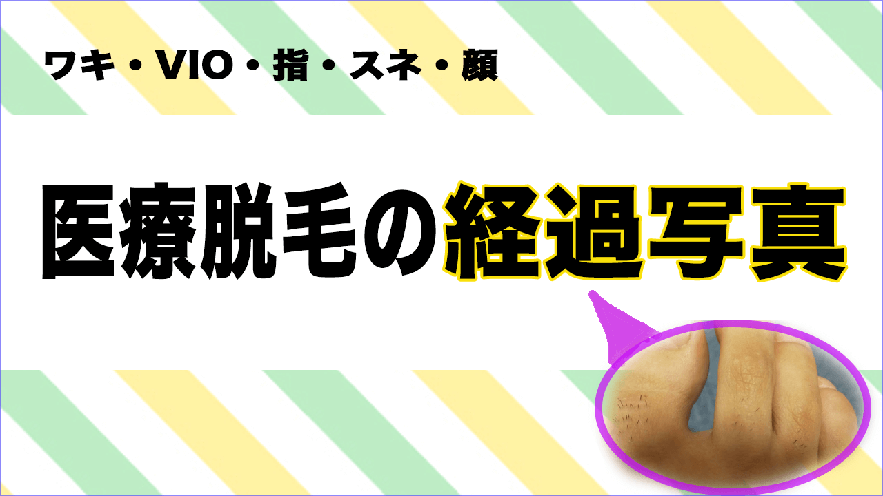 医療脱毛は効果ある 写真付きで経過を紹介 顔 足 指 Vio 脇 ゴモブロ 剛毛女の医療脱毛ブログ