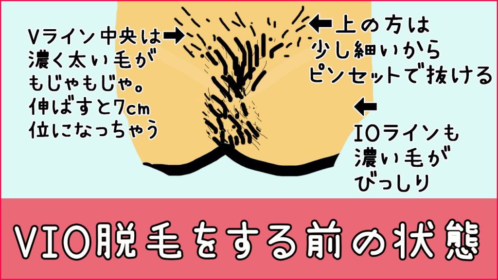 写真あり・医療脱毛の効果と経過（顔・足・指・VIO・脇）｜ゴモブロ-剛毛女の医療脱毛ブログ-